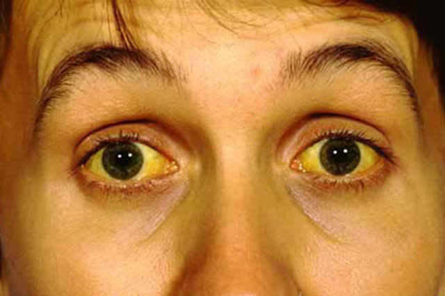 Vàng da, vàng mắt do chức năng gan suy yếu không đào thải được hết Bilirubin