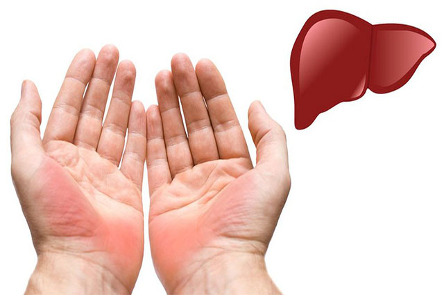 Lòng bàn tay đỏ là một trong những biểu hiện đặc trưng của người gan nhiễm mỡ cao