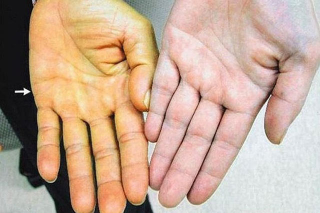 Nóng gan dẫn đến tích tụ Bilirubin trong máu gây ra hiện tượng vàng da