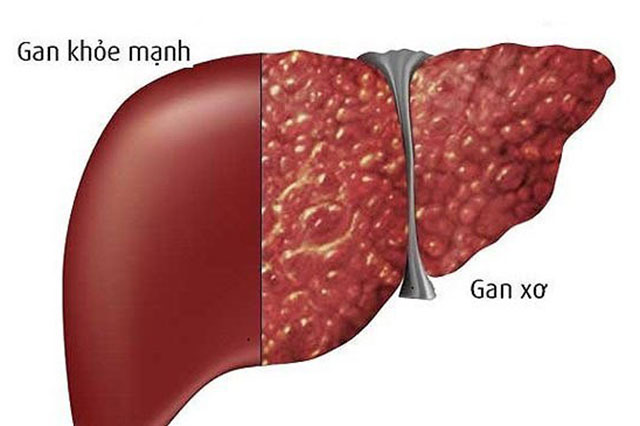 Bệnh xơ gan khó chữa nhưng dễ phòng ngừa, ngăn chặn từ sớm