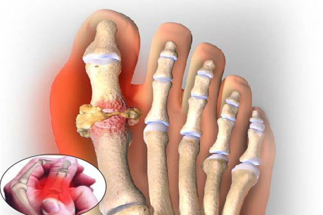 Gout – Bệnh lý xương khớp đang ngày càng đáng báo động ở giới trẻ