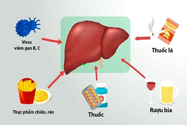 Những thói quen xấu tổn hại đến gan nên tránh