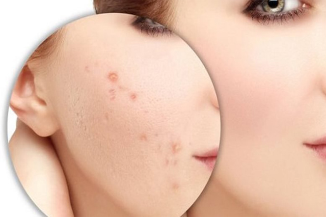 Làn da mặt nhạy cảm rất hay bị tác động các yếu tố tự nhiên
