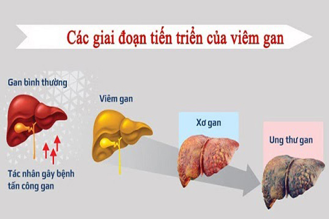 Những bệnh lý thường xảy đến với gan