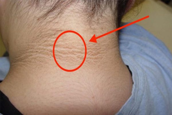 Những nguyên nhân khiến da vùng cổ và gáy bị thâm sạm