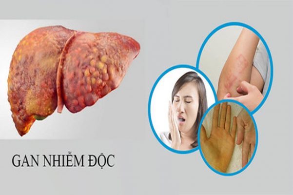 Gan bị nhiễm độc: Nguyên nhân và cách phòng ngừa