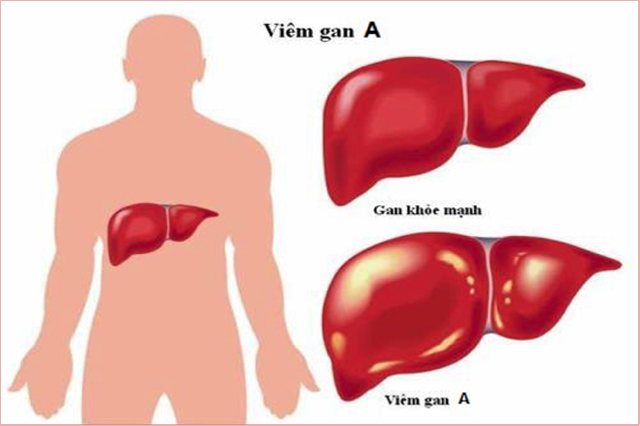 Viêm gan A: Nguyên nhân, triệu chứng và cách phòng ngừa