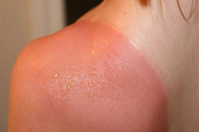 Cháy nắng là tình trạng da bị ửng đỏ và bỏng rát