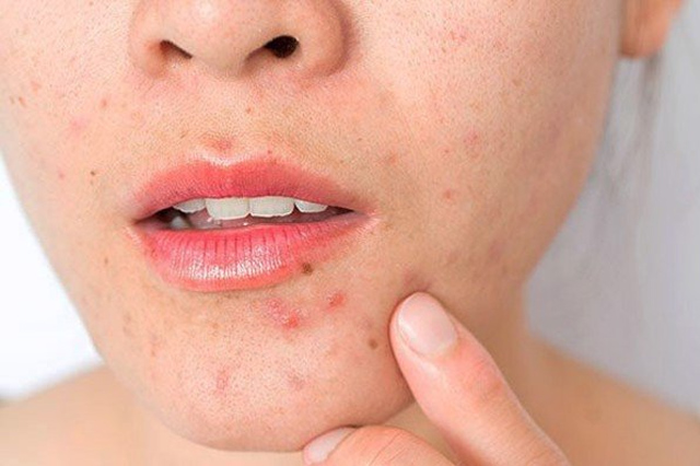 Da mặt yếu dễ nổi mụn: Nguyên nhân và gợi ý chu trình chăm sóc cho da