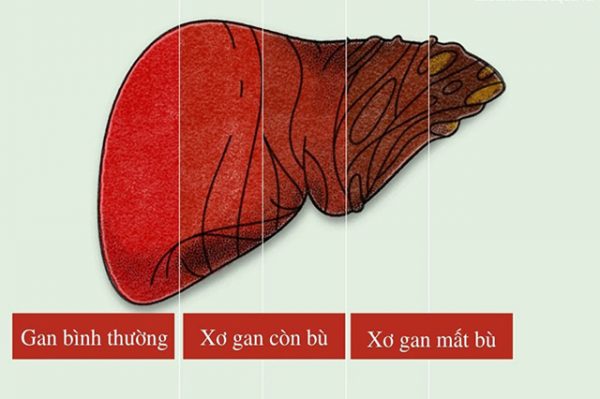 Hội chứng suy tế bào gan - Giai đoạn đầu của xơ gan rất nguy hiểm
