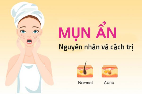 Mụn ẩn dưới da mặt: Nguyên nhân và cách phòng ngừa hiệu quả