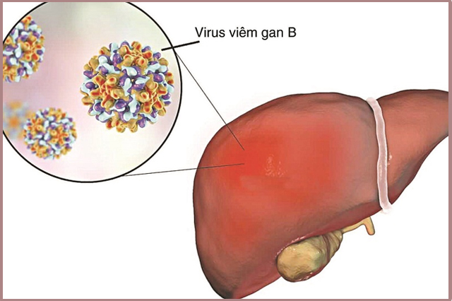 Viêm gan B là nguyên nhân hàng đầu dẫn đến các bệnh suy gan, xơ gan