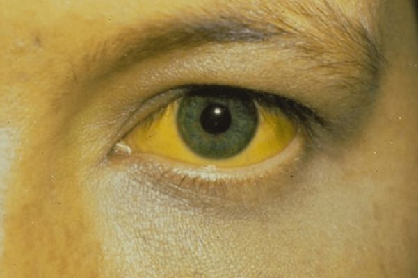 Vàng da ở người thường liên quan đến những bệnh nào?