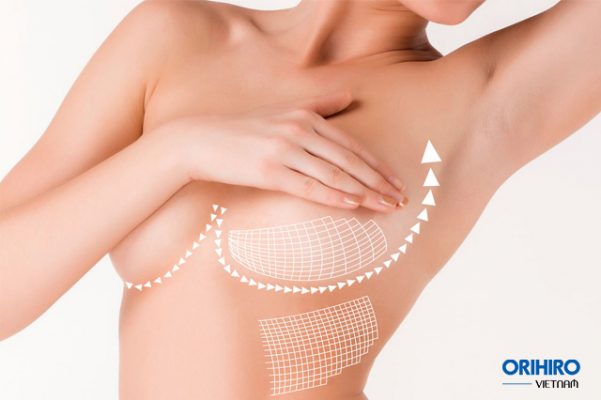 Có nhiều cách để nâng ngực chảy xệ không cần phẫu thuật hiệu quả