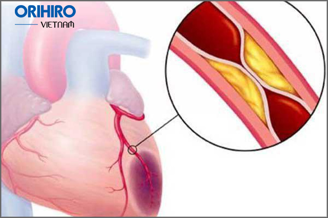 Mỡ nội tạng nguy hiểm như thế nào?