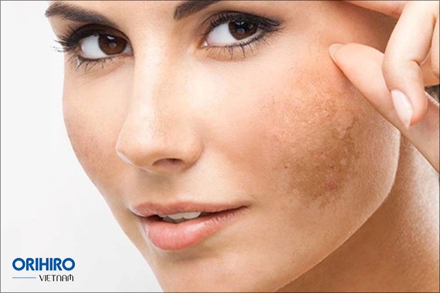 Da mặt bị thâm sạm và cách khắc phục đơn giản, hiệu quả tại nhà