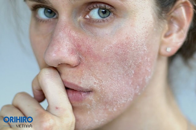 Da khô, thô ráp, sần sùi – Dấu hiệu da bị mất cân bằng độ ẩm dễ nhận thấy nhất