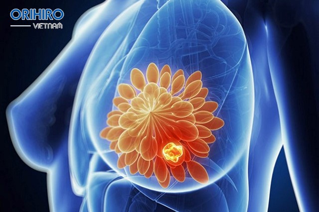 Trà Atiso chống lại và ngăn ngừa tế bào ung thư, đặc biệt là ung thư vú