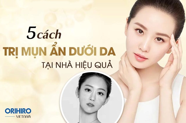 Bật mí 5 phương pháp đẩy mụn ẩn dưới da an toàn, đơn giản tại nhà