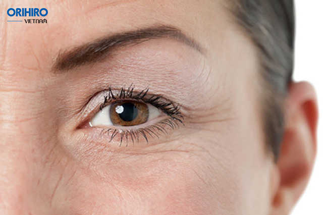 Làm thế nào để ngăn ngừa nếp nhăn ở mắt hiệu quả?