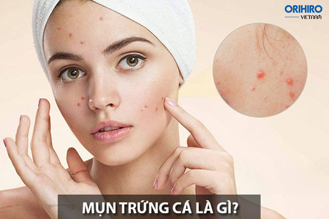 Mụn trứng cá là gì?