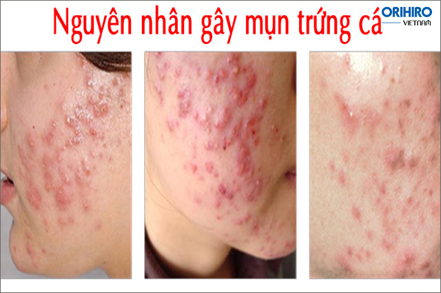 Những nguyên nhân gây ra mụn 