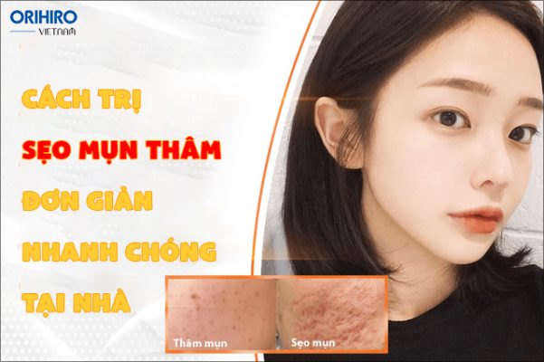 5 cách trị sẹo mụn thâm đơn giản, nhanh chóng nhất tại nhà