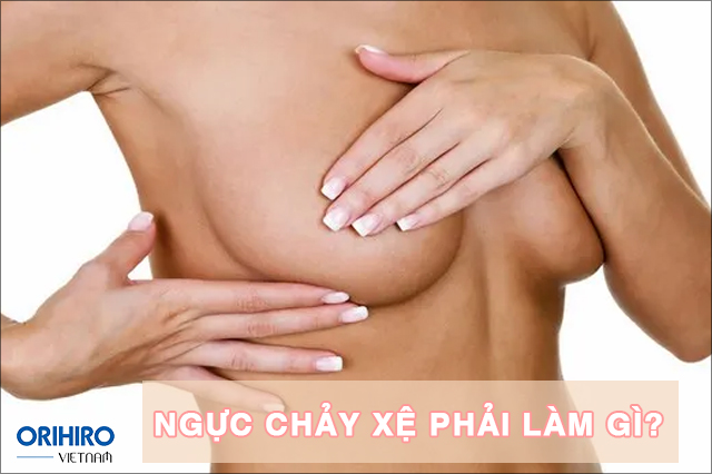 Ngực chảy xệ phải làm gì? Cách khắc phục tốt nhất hiện nay