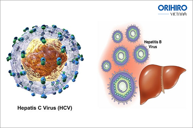 Virus viêm gan B và C tiềm ẩn nguy cơ ung thư gan