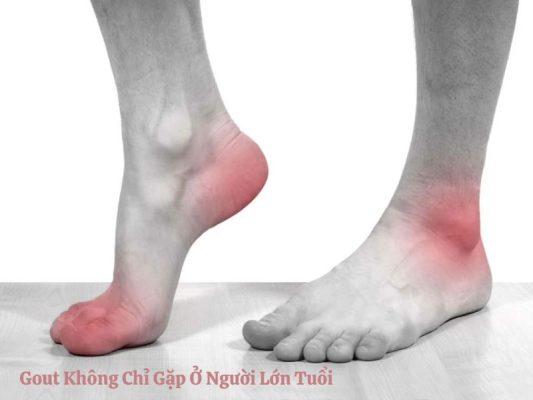 Gout Không Chỉ Gặp Ở Người Lớn Tuổi – Người Trẻ Cũng Nên Cẩn Trọng