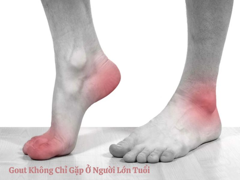 Gout Không Chỉ Gặp Ở Người Lớn Tuổi – Người Trẻ Cũng Nên Cẩn Trọng