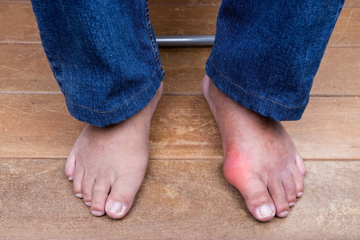 Triêu chứng Gout: Sưng, đỏ, đau tại khớp ngón chân
