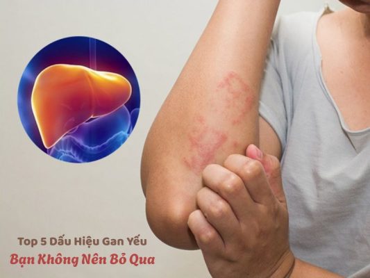 Top 5 Dấu Hiệu Gan Yếu Bạn Không Nên Bỏ Qua