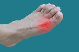 Bệnh gout là gì? Là bệnh liên quan đến xương khớp do rối loạn chuyển hóa acid uric