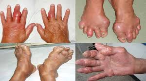 Biến chứng nặng nề của bệnh gout