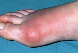 Bệnh gout là gì? Là dạng viêm khớp do rối loạn chuyển hóa acid uric