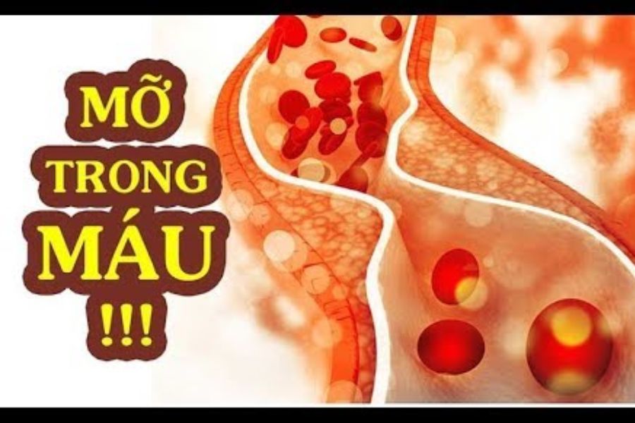 Hiểu rõ làm gì để giảm mỡ máu để bảo vệ tim mạch