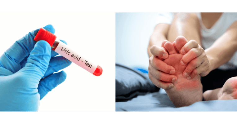 Tăng acid uric là hệ quả của rối loạn chuyển hóa