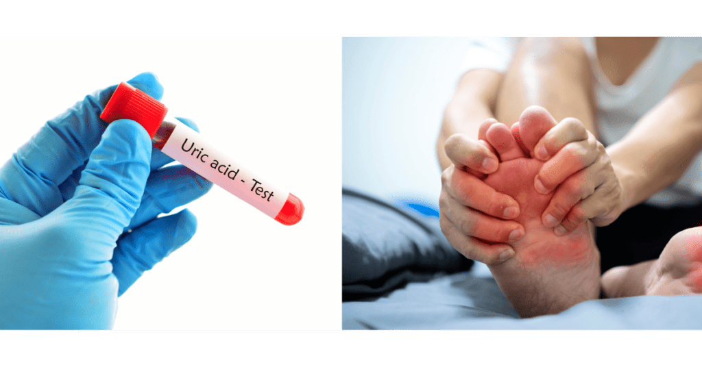 Tăng acid uric là hệ quả của rối loạn chuyển hóa