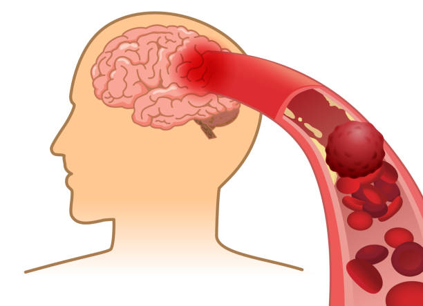 Tuần hoàn máu não là quá trình vận chuyển máu từ tim lên não