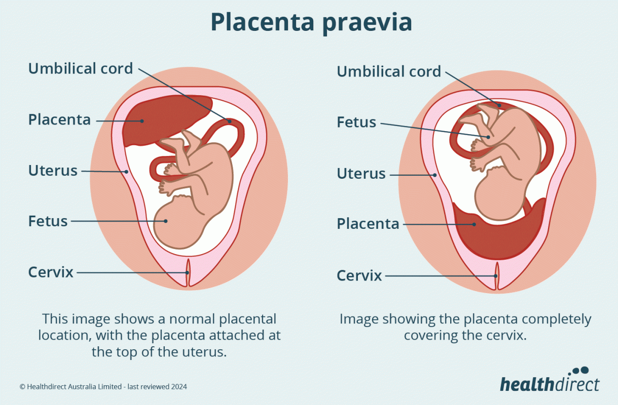 Nhau thai Placenta là phần chứa dinh dưỡng nuôi thai nhi