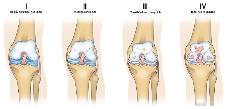 Thoái hóa khớp gối là tình trạng sụn khớp bị mài mòn