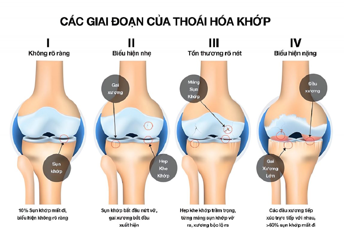 Mỗi gia đoạn của thoái hóa khớp gối thì có các triệu chứng khác nhau